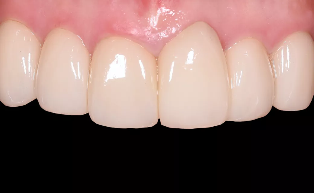 ブロック削り出しベニア