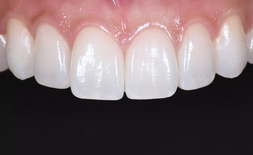 筆積み技法による当院の仕上がり