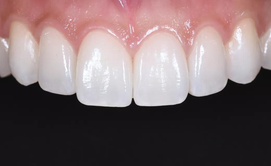 ラミネートベニア〈セラフィルム〉