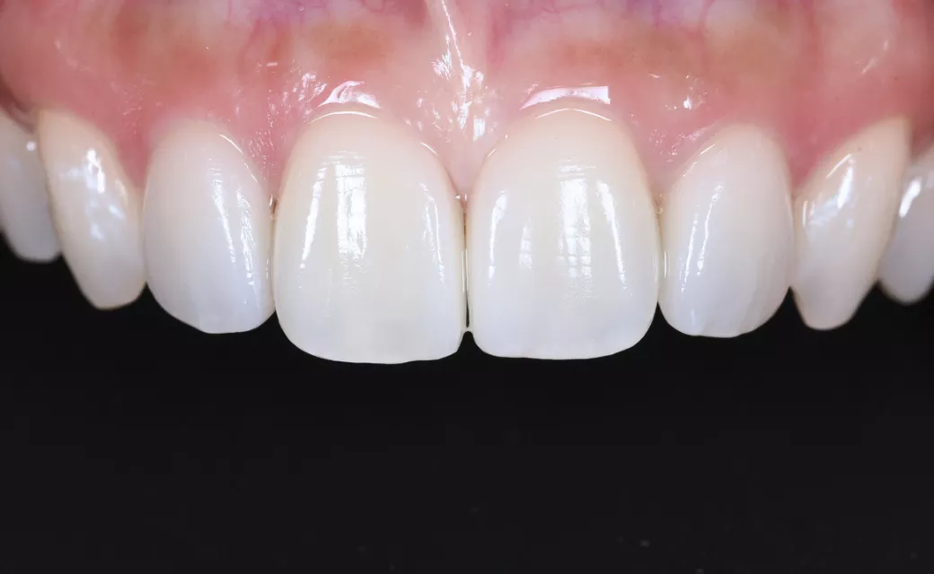 ラミネートベニア〈セラフィルムゼロ〉