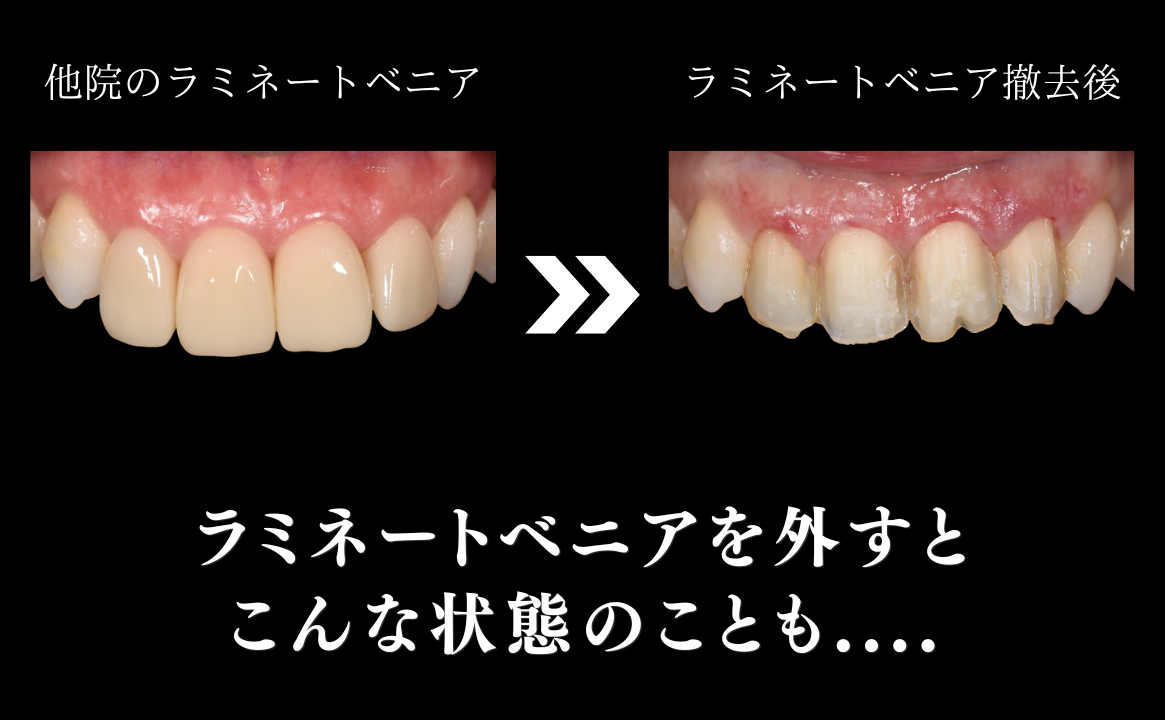 他院で行ったラミネートベニアで多いお悩み