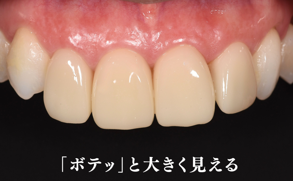 歯が「ボテッ」と見える(厚みで輪郭が大きく見える)