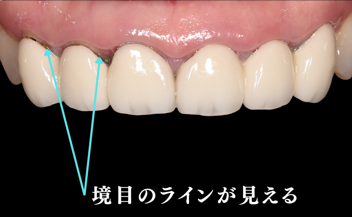 歯ぐきとの境目のラインが見える