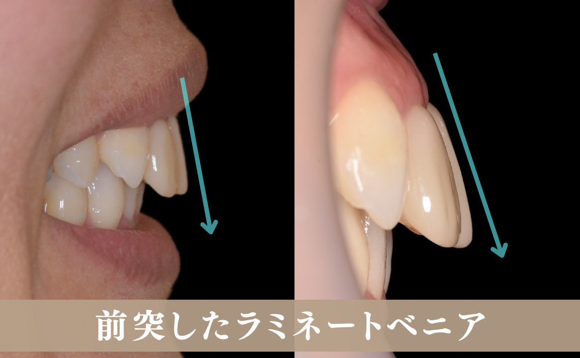 前に突出した感じ「出っ歯っぽい」