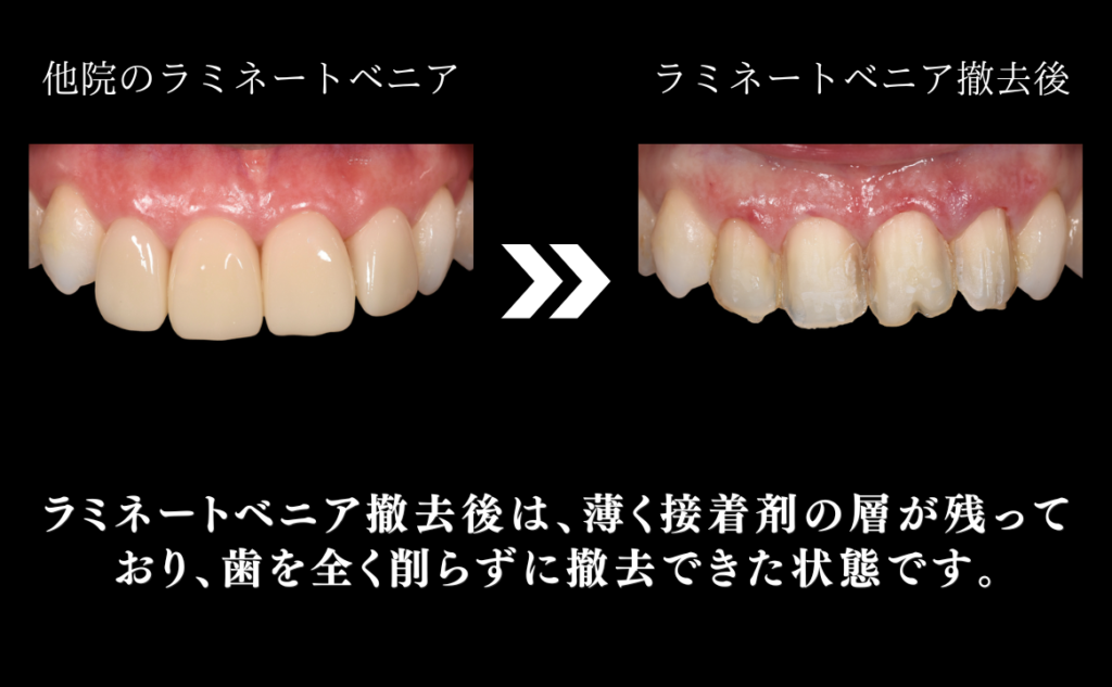 「他院のラミネートベニア → ラミネートベニア撤去後」比較写真