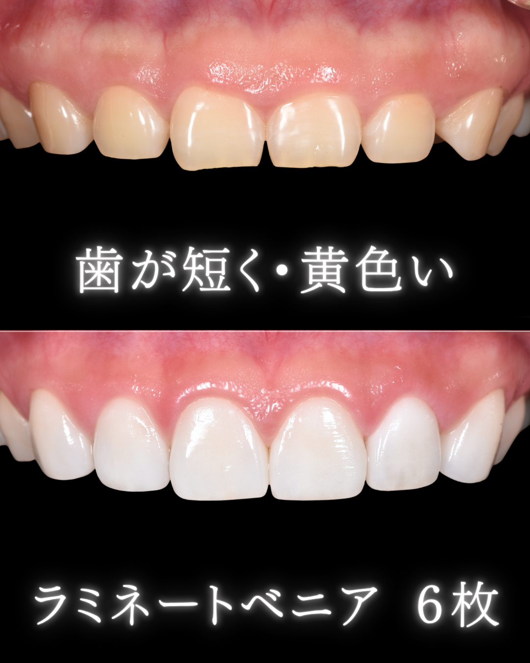 症例紹介 | 削らないラミネートベニア専門サイト【大阪】