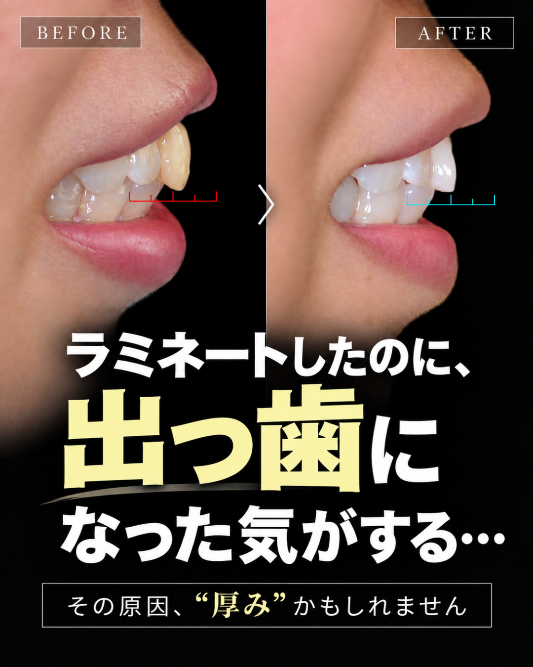 症例紹介 | 削らないラミネートベニア専門サイト【大阪】